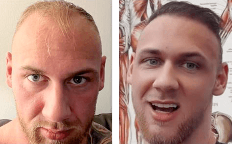 Anders fra Kobenhavn 5000 grafts fordelt over hele hovedet