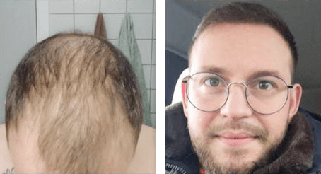 Arif fra Jylland 5500 grafts fordelt over hele hovedet