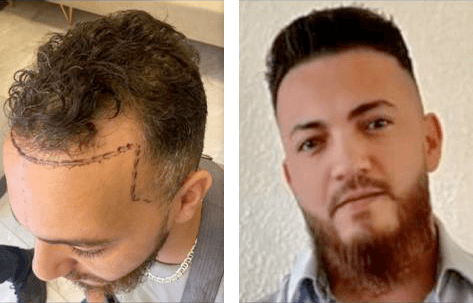 Benjamin fra Jylland 3900 grafts ved front omradet tindingerne