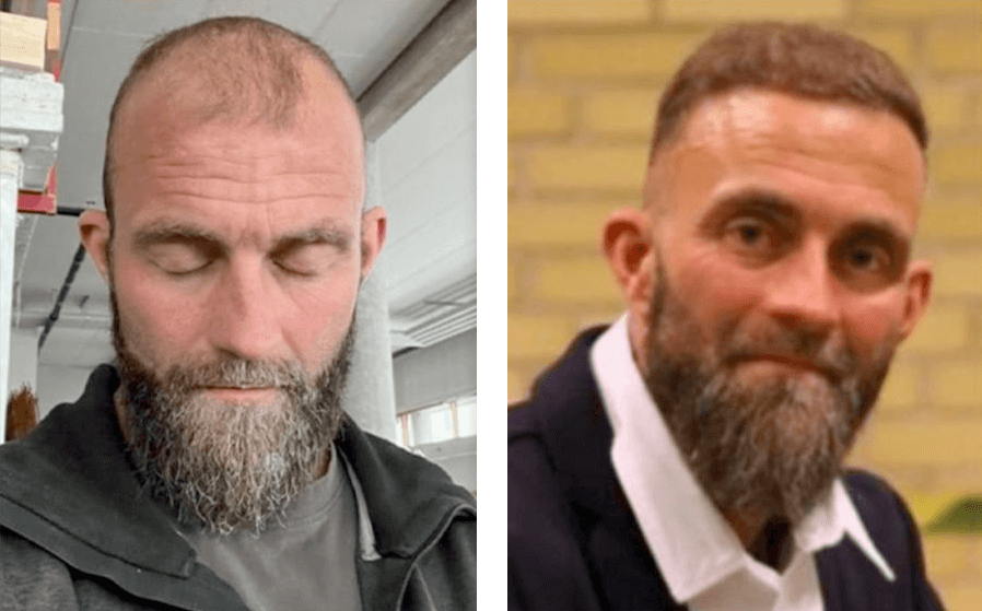 Cliff fra Kobenhavn 5700 grafts fordelt over hele hovedet