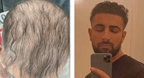 Haidar fra Kobenhavn 4500 grafts fordelt over hele hovedet