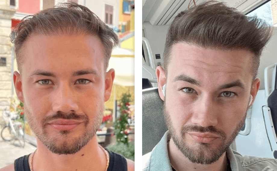 Kasper fra Kobenhavn 4000 grafts front omrade