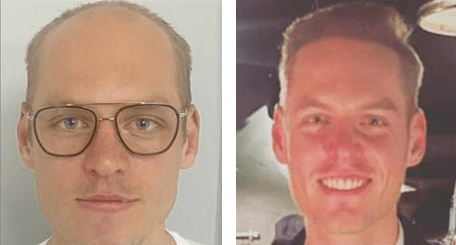 Mads fra Kobenhavn 5800 grafts fordelt over hele hovedet