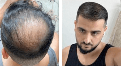 Simko fra Jylland 4000 grafts som blev fordelt ved maane regionen